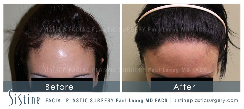 Hair Transplant Before & After Gallery - Patient 4883728 - Image 1