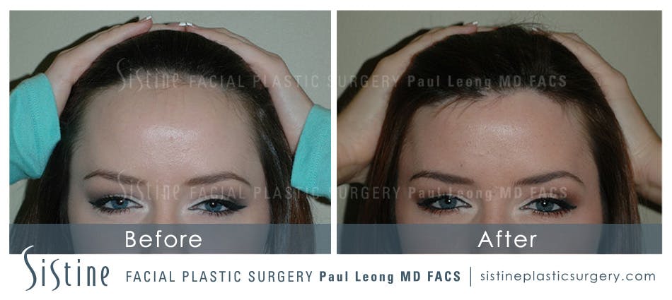 Hair Transplant Before & After Gallery - Patient 4883729 - Image 1