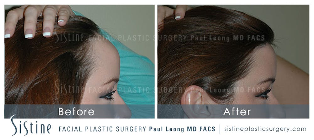 Hair Transplant Before & After Gallery - Patient 4883729 - Image 2