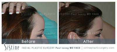 Hair Transplant Before & After Gallery - Patient 4883729 - Image 2