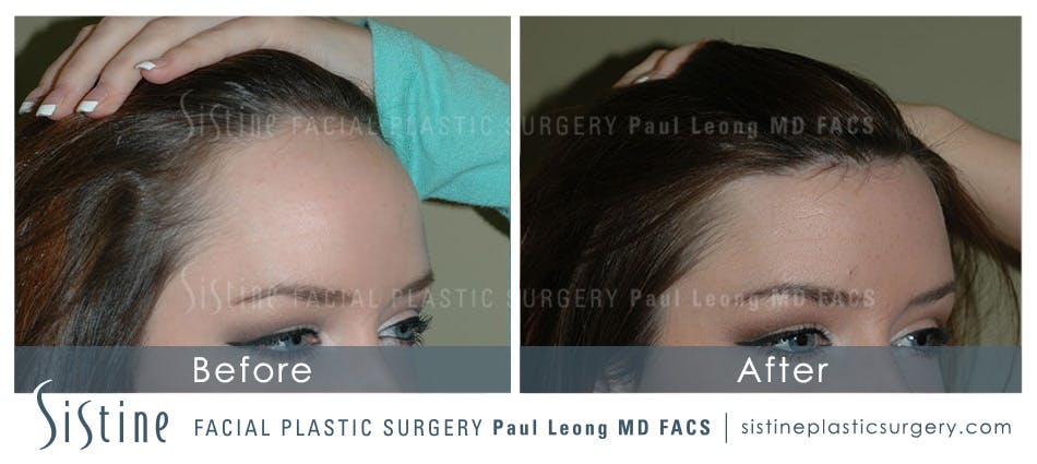 Hair Transplant Before & After Gallery - Patient 4883729 - Image 3