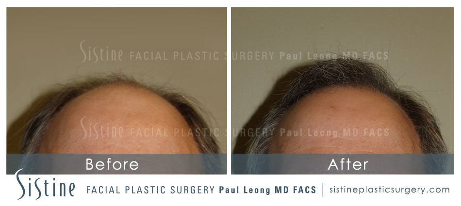 Hair Transplant Before & After Gallery - Patient 4883731 - Image 2