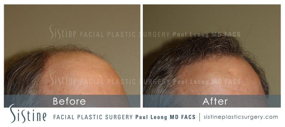 Hair Transplant Before & After Gallery - Patient 4883731 - Image 4