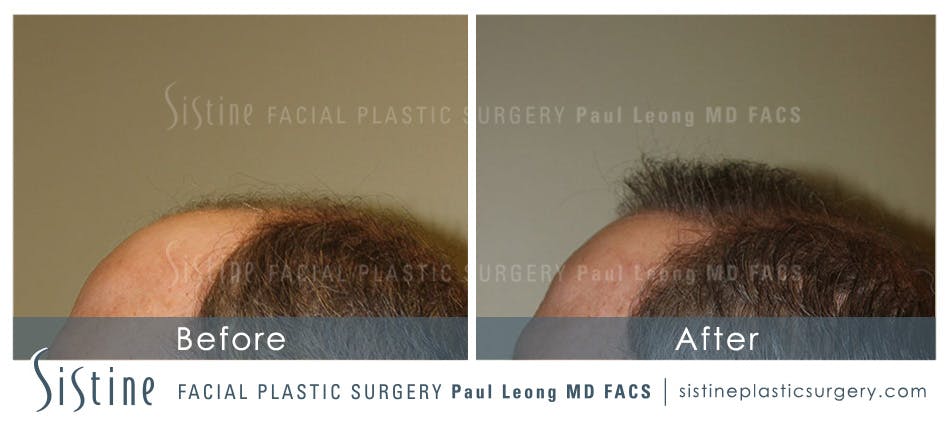 Hair Transplant Before & After Gallery - Patient 4883731 - Image 5