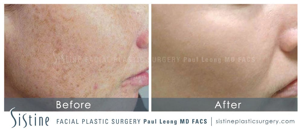 Photofacial Before & After Gallery - Patient 4883736 - Image 1
