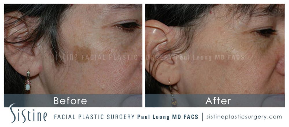 Photofacial Before & After Gallery - Patient 4883737 - Image 1