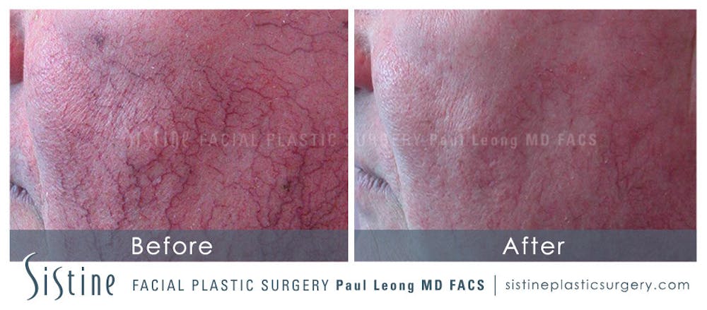 Photofacial Before & After Gallery - Patient 4883739 - Image 1