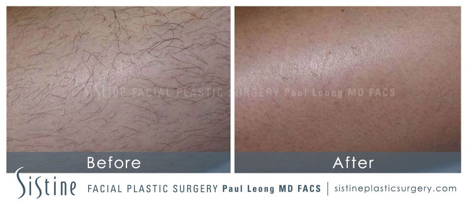 Laser Hair Removal Before & After Gallery - Patient 4883743 - Image 1