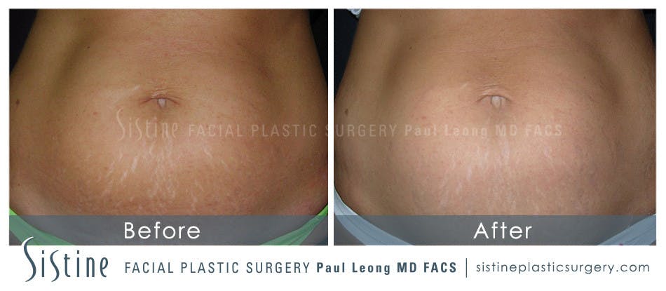 Stretch Marks Before & After Gallery - Patient 4883744 - Image 1