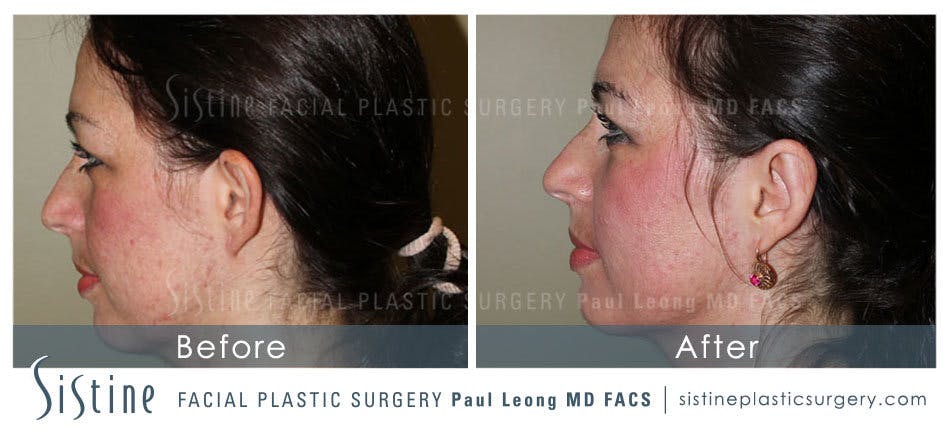Otoplasty Before & After Gallery - Patient 4883777 - Image 2