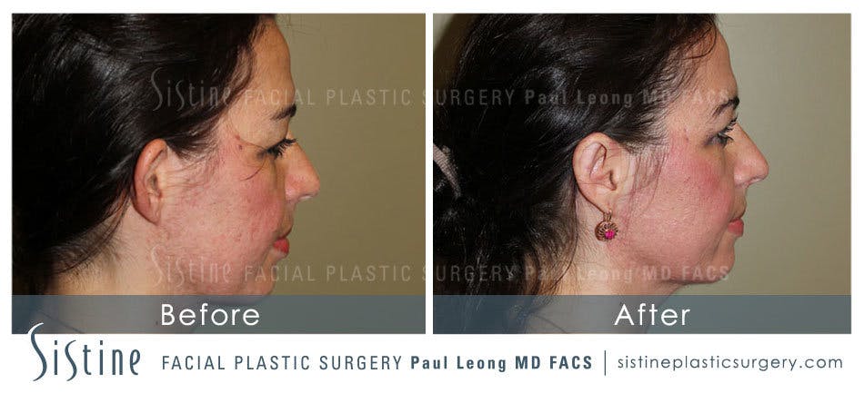 Otoplasty Before & After Gallery - Patient 4883777 - Image 3
