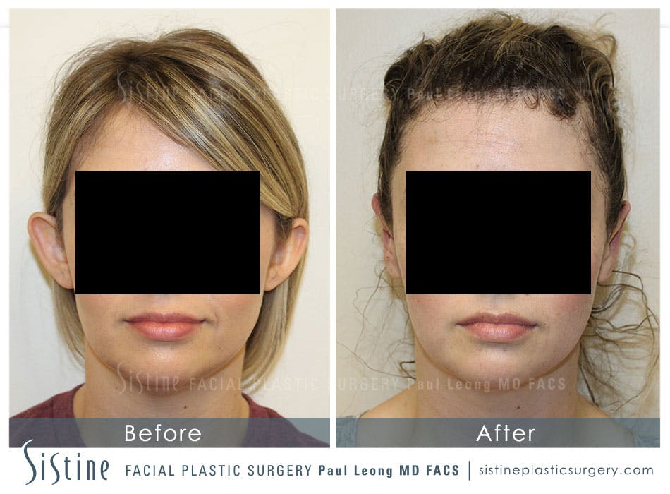 Otoplasty Before & After Gallery - Patient 4883779 - Image 1