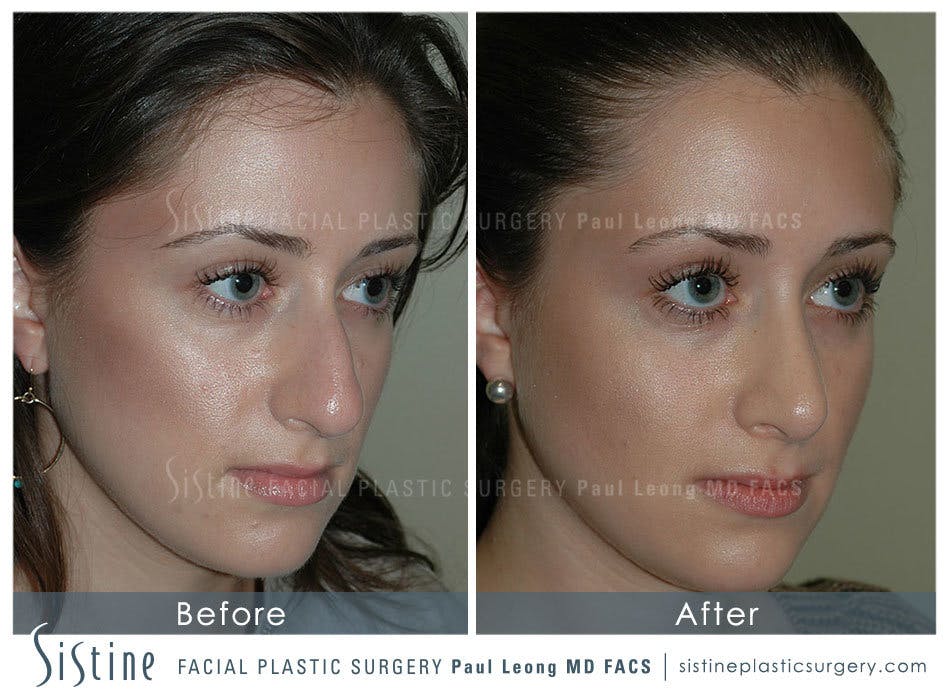 Rhinoplasty Before & After Gallery - Patient 4883788 - Image 2
