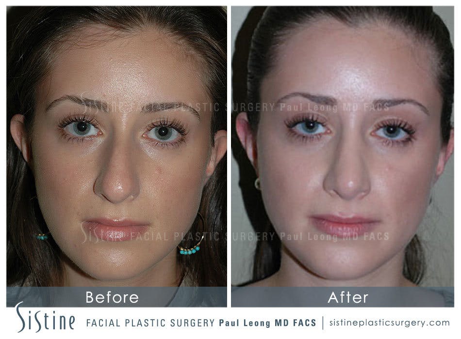 Rhinoplasty Before & After Gallery - Patient 4883788 - Image 3