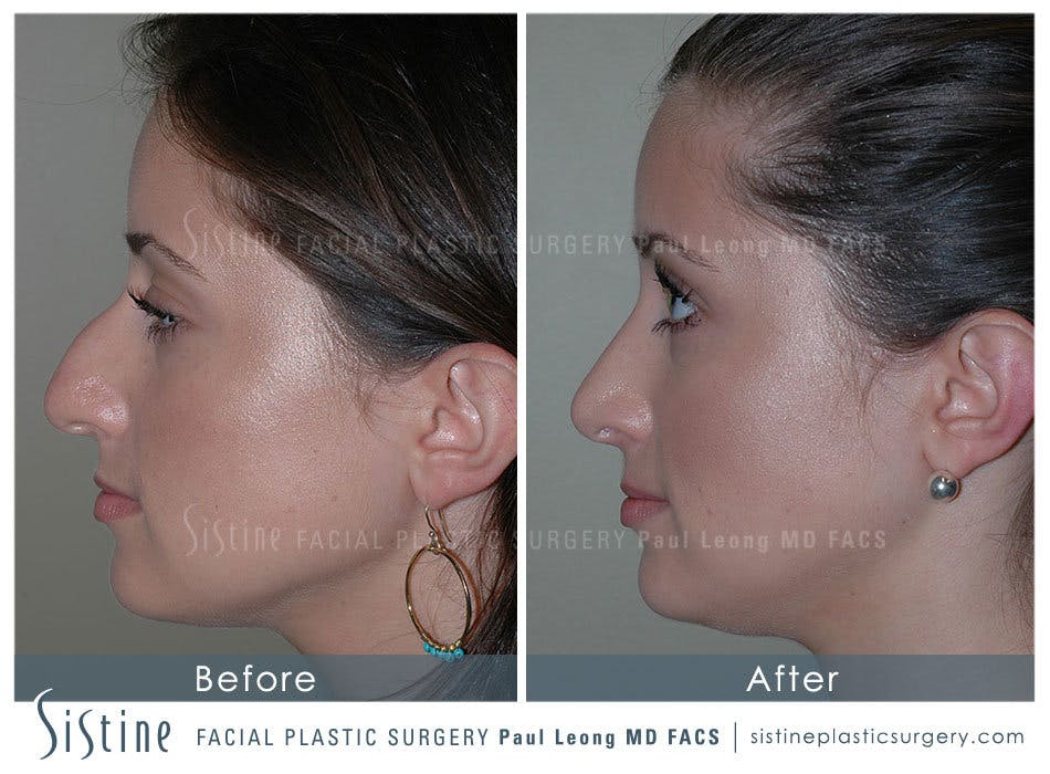 Rhinoplasty Before & After Gallery - Patient 4883788 - Image 5