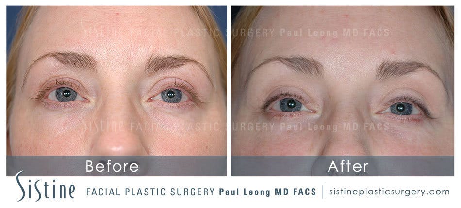 Browlift Before & After Gallery - Patient 4883792 - Image 1