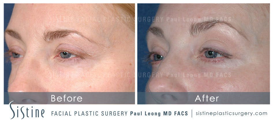 Browlift Before & After Gallery - Patient 4883792 - Image 2