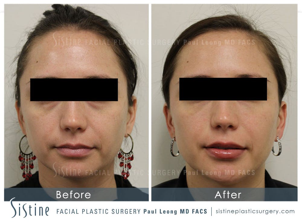 Brow and Forehead Before & After Gallery - Patient 4883804 - Image 1
