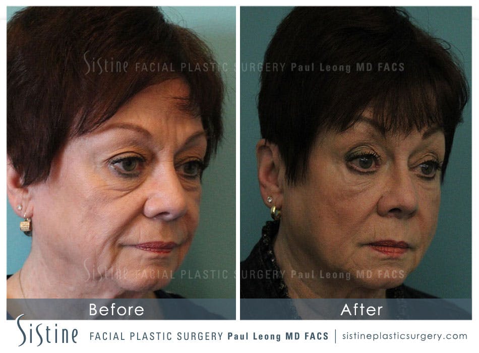 Cheeks Before & After Gallery - Patient 4883806 - Image 2