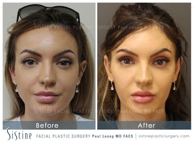 Chin, Jaw and Neck Before & After Gallery - Patient 4884542 - Image 1