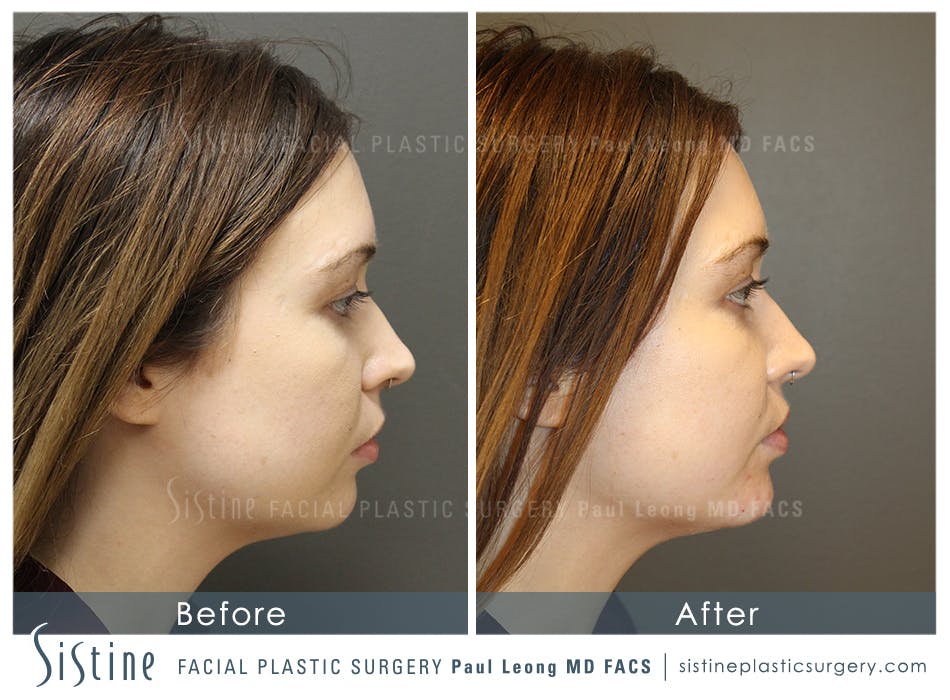 Chin, Jaw and Neck Before & After Gallery - Patient 4884540 - Image 1