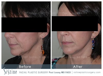 Ears Before & After Gallery - Patient 4884552 - Image 2