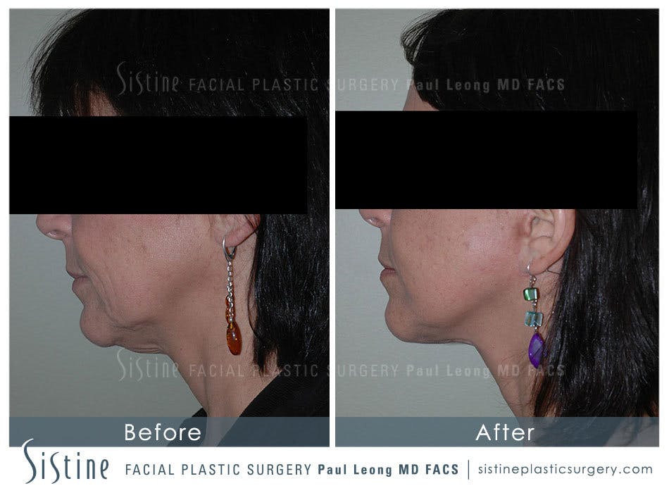 Ears Before & After Gallery - Patient 4884552 - Image 3