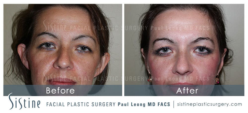 Ears Before & After Gallery - Patient 4884558 - Image 1