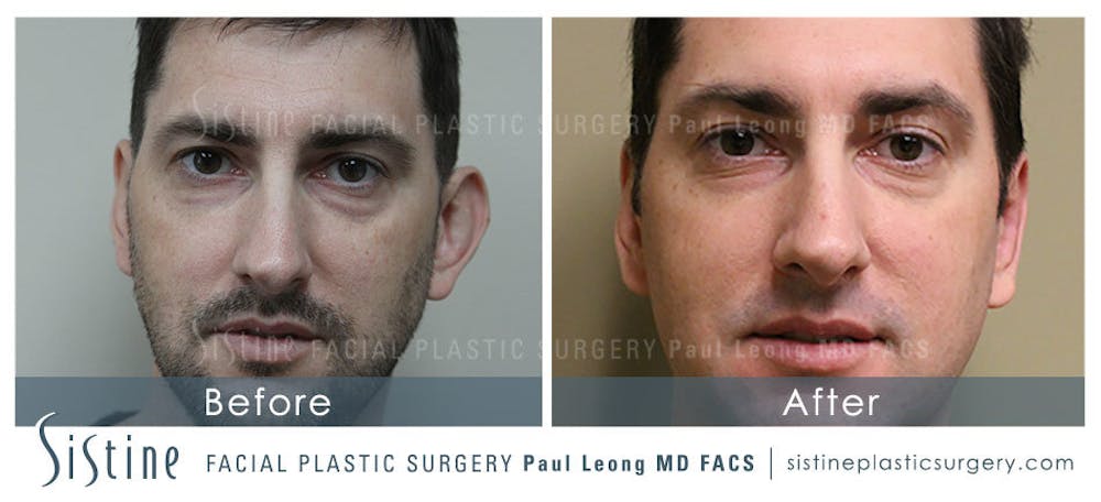 Ears Before & After Gallery - Patient 4884559 - Image 1