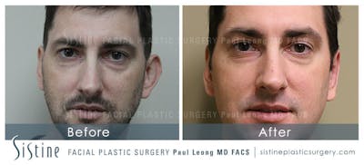 Ears Before & After Gallery - Patient 4884559 - Image 1