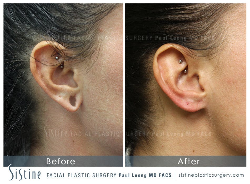 Ears Before & After Gallery - Patient 4889601 - Image 2