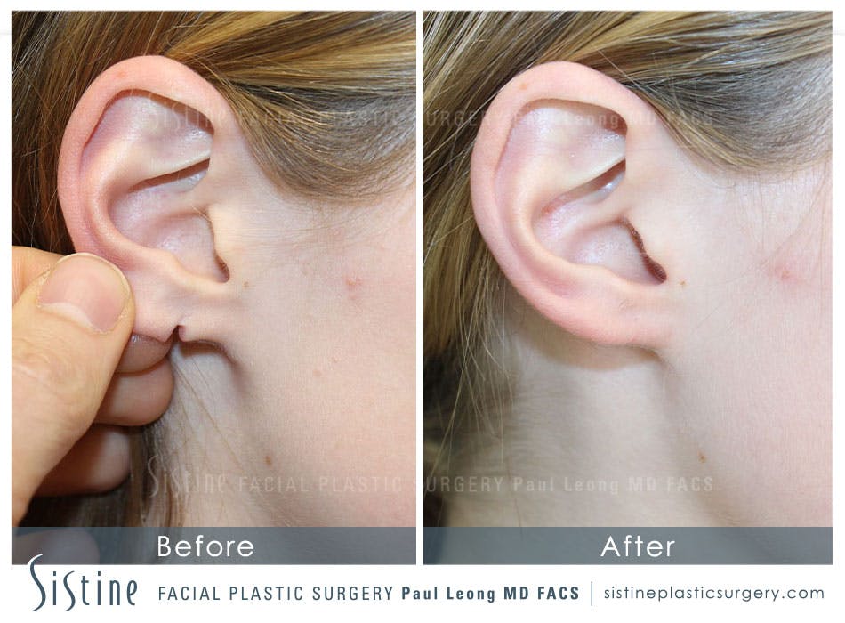 Ears Before & After Gallery - Patient 4889615 - Image 1