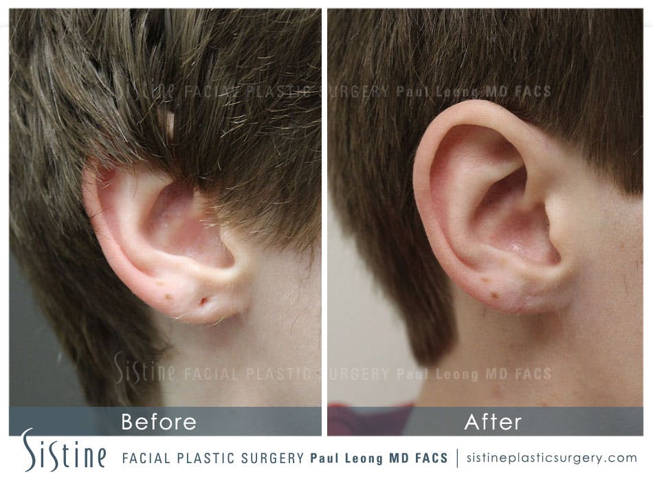Ears Before & After Gallery - Patient 4889616 - Image 2