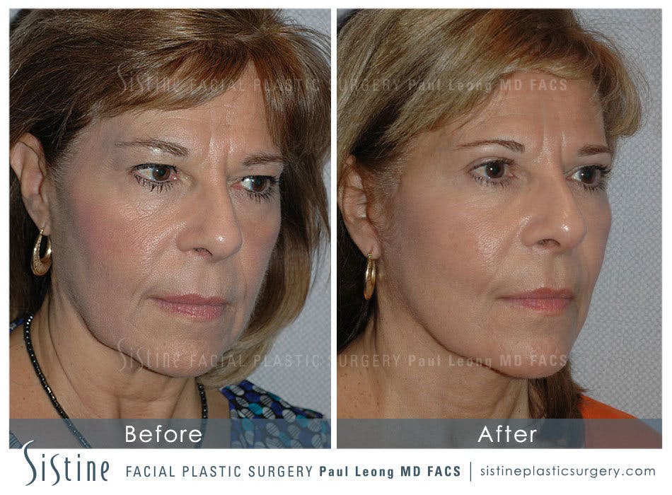 Eyes Before & After Gallery - Patient 4889641 - Image 2