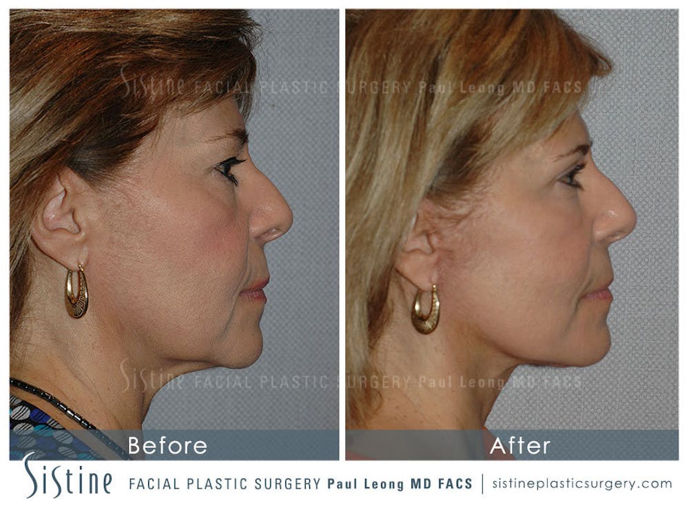 Eyes Before & After Gallery - Patient 4889641 - Image 3