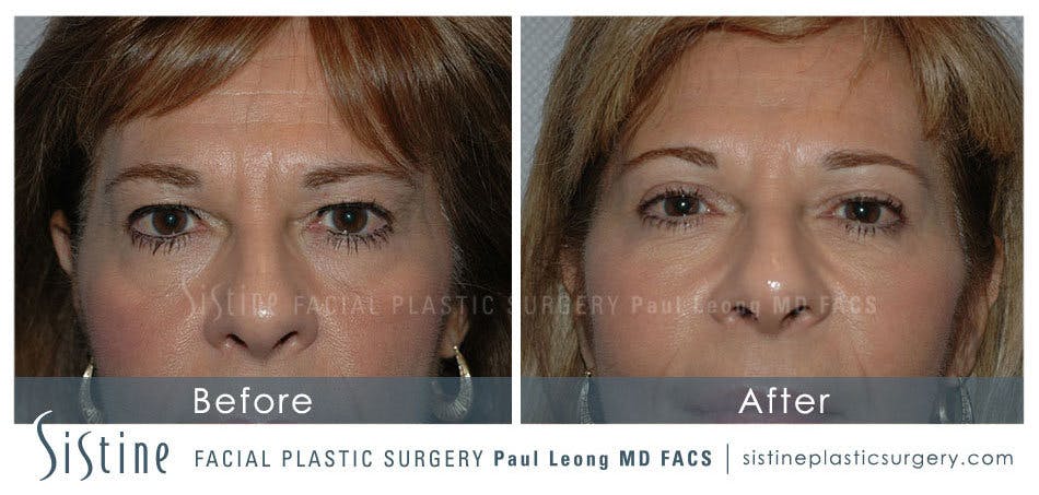 Eyes Before & After Gallery - Patient 4889641 - Image 4