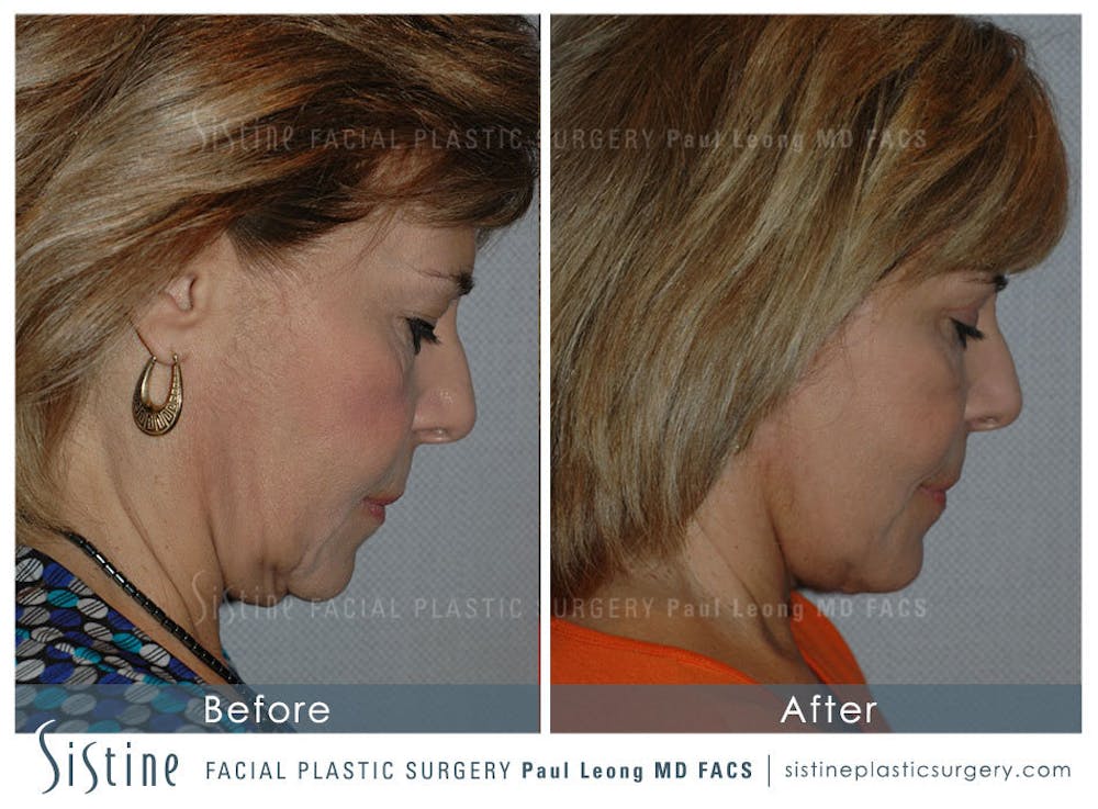 Eyes Before & After Gallery - Patient 4889641 - Image 5