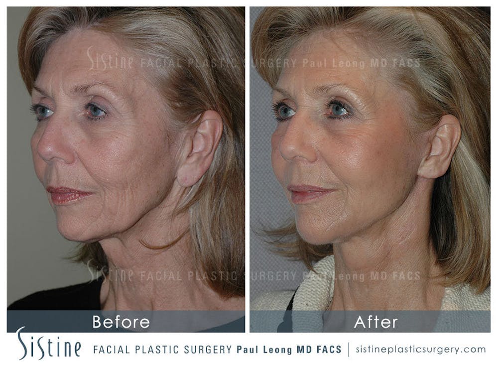 Eyes Before & After Gallery - Patient 4889650 - Image 3