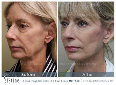 Eyes Before & After Gallery - Patient 4889671 - Image 2