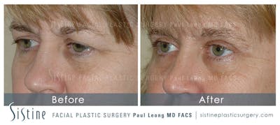 Eyes Before & After Gallery - Patient 4889742 - Image 2