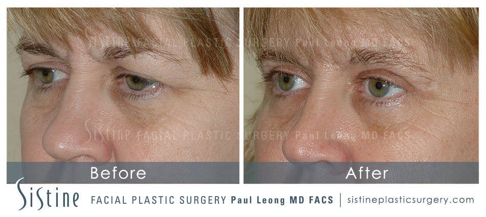 Eyes Before & After Gallery - Patient 4889742 - Image 2