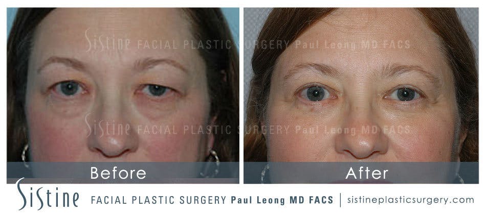 Eyes Before & After Gallery - Patient 4889744 - Image 1