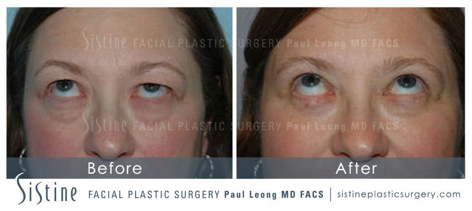 Eyes Before & After Gallery - Patient 4889744 - Image 3