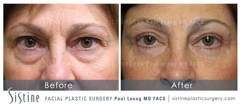 Eyes Before & After Gallery - Patient 4889800 - Image 1
