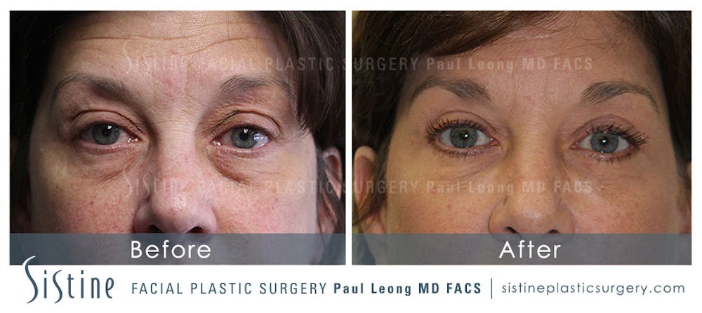 Eyes Before & After Gallery - Patient 4889801 - Image 1