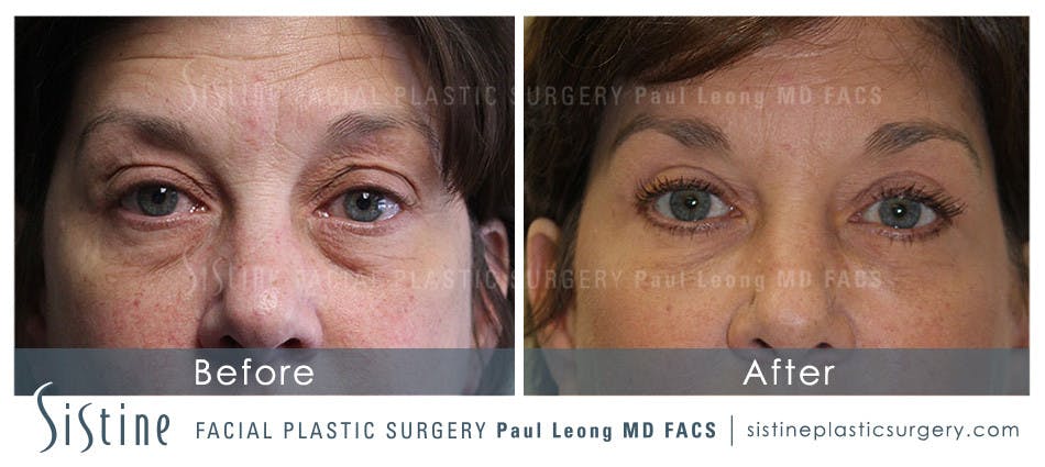 Eyes Before & After Gallery - Patient 4889801 - Image 1