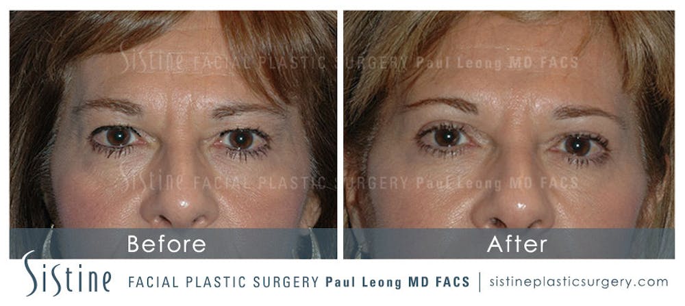 Eyes Before & After Gallery - Patient 4889802 - Image 1