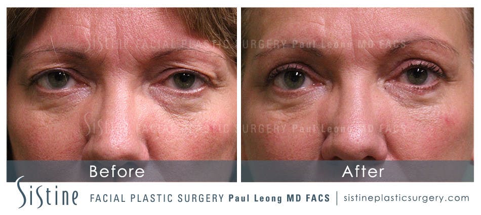 Eyes Before & After Gallery - Patient 4889803 - Image 1