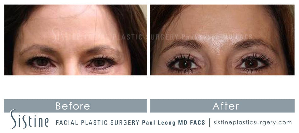 Eyes Before & After Gallery - Patient 4889804 - Image 1