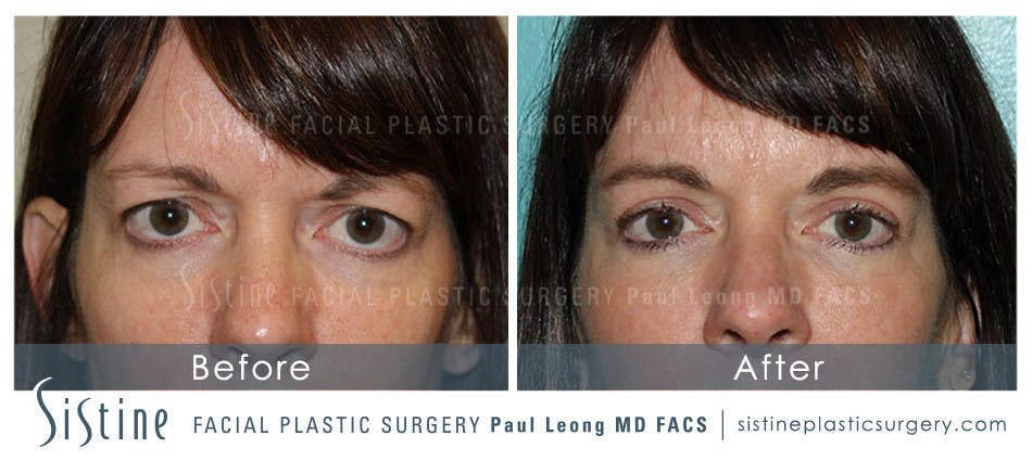 Eyes Before & After Gallery - Patient 4889809 - Image 1